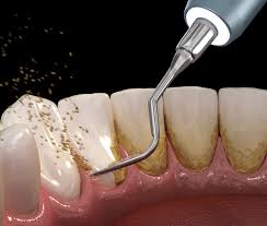 Deep Scaling And Root Planing | Periodontal Procedures