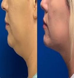 Double Chin/Neck Fat Removal | Double Chin Surgery