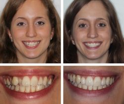 Tooth Restoration Dental Services in Houston,TX | Metal-Free Dental Restorations