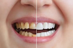 Dental Bonding Before And After | teeth bonding near me