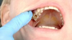 Root Canals Specialists Near Me