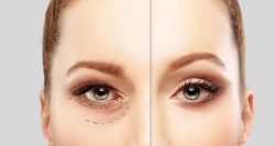 Eyelid Surgery Near Me | Eye Lift Surgery Houston