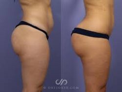 Brazilian Butt Lift Before and After?