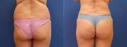 Brazilian Buttock Lift Before & After?