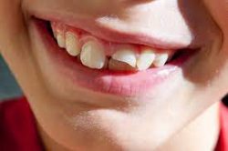 Chipped Tooth: Repair, Costs, and Treatment