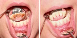 Deep Scaling And Root Planing | Gum Disease