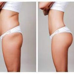 Liposuction Results Before And After | Lipsosuction