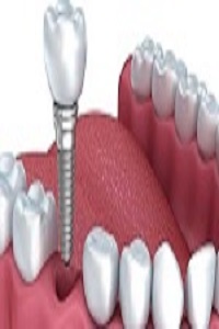 Affordable Dental Implants Near Me |Affordable Implants