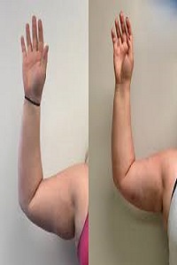 Arm Lipo Before and After |Arm liposuction