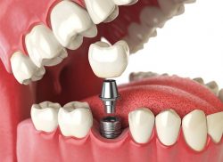 Stages of the Dental Implant Procedure |Dental Procedure