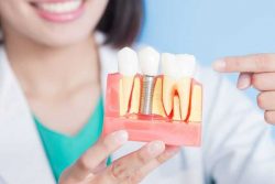 Dental Implant Specialist Near Me |procedure in Houston