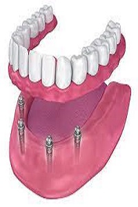 Affordable Dental Implants in Houston | teeth replacement
