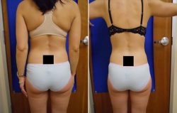 Laser Fat Removal Options, Costs, and Results | fat removal
