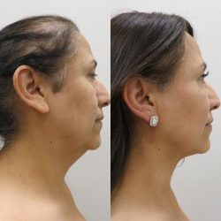 Double Chin/Neck Fat Removal |fat removal