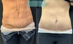Tummy Tuck Before and After Pictures |tummy tuck