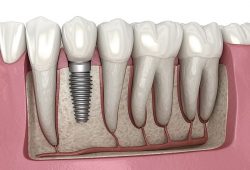 Different Types of Dental Implants | teeth replacement