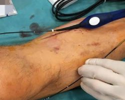 What is a Varicose Vein Specialist Called?