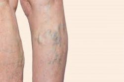 can you reverse venous insufficiency