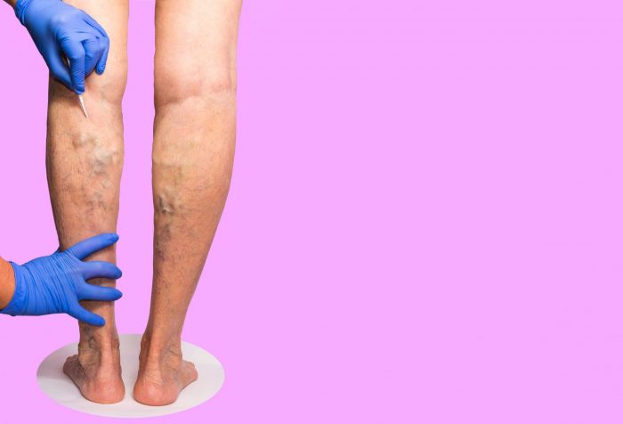can venous insufficiency be cured