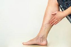 What Can Go Wrong With Sclerotherapy