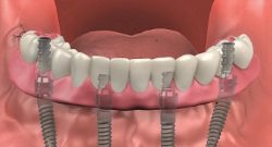 Full Mouth Dental Implants: What You Need to Know