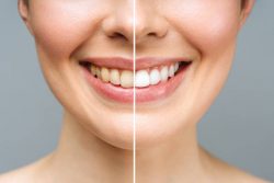 Affordable Dentures in Woodbridge, VA – Smile Confidently Without Breaking the Bank!