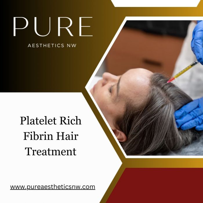 Platelet Rich Fibrin Hair Treatment