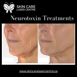 Neurotoxin Treatments