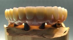 Veneers in Tijuana