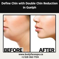 Define Chin with Double Chin Reduction in Guelph