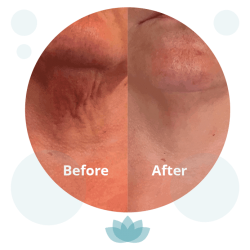 Discover Radiant Skin with Profhilo Treatment at RejuvaMed Skin Clinic