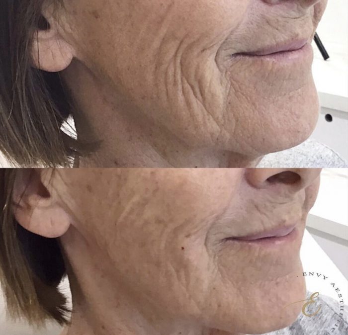 Envy Aesthetics – Best Skin Booster Injections for Radiance and Hydration