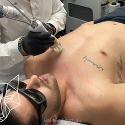 Chest Hair Removal Sydney – Smooth, Confident, and Hassle-Free Grooming
