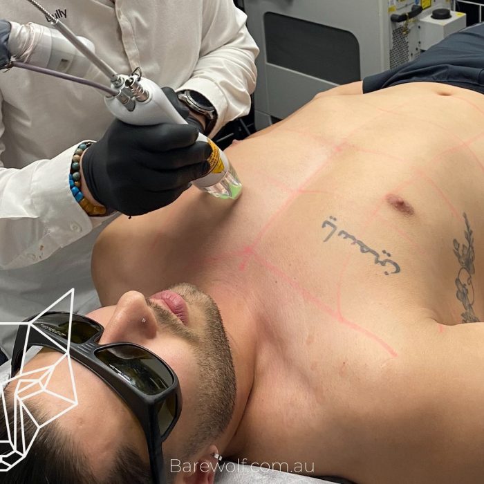 Chest Hair Removal Sydney – Smooth, Confident, and Hassle-Free Grooming