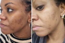 Laser removal of skin tag