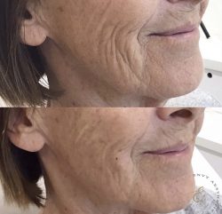 Envy Aesthetics – Hydrating Skin Boosters Injections for Radiant Skin