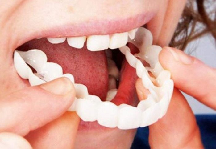 What Are the Benefits of Choosing Full Arch Dental Implants in Houston?