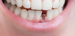 How Long Does the All-on-Four Dental Implant Procedure Take?