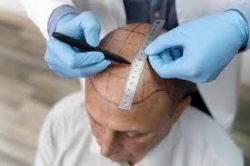 Dr Ditta Hair Transplants – DHI Hair Transplant Services in Manchester