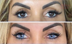 What Influences Keratopigmentation Cost Today?