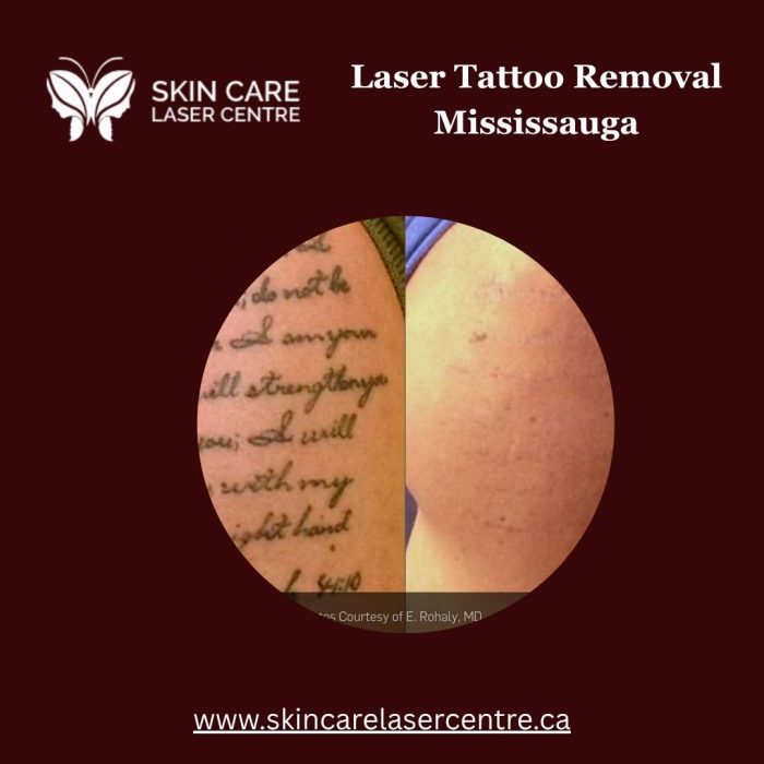 Laser Tattoo Removal Mississauga
