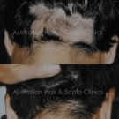 Natural Hair Restoration Treatment in Sydney