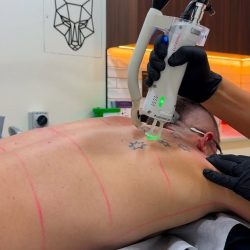 Hair Removal For Men Rose Bay – Effective Male Hair Removal