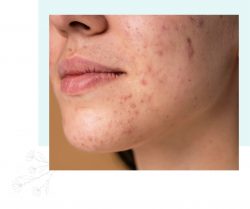 Pigmentation Treatment in Malaysia by Dr Laviniya Naidu
