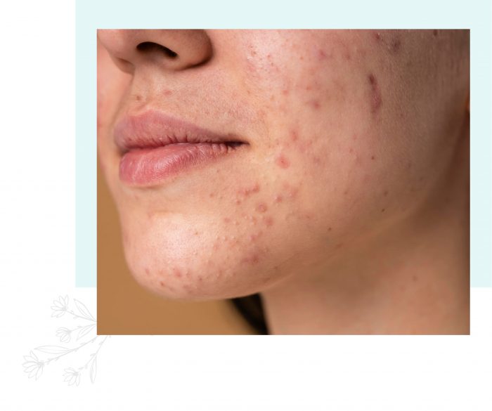 Pigmentation Treatment in Malaysia by Dr Laviniya Naidu