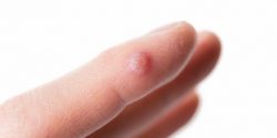Dermatologist Wart Removal – Safe and Effective at London Dermatology Clinics