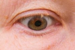 Skin Tag Removal on Eyelid – Gentle Expert Care