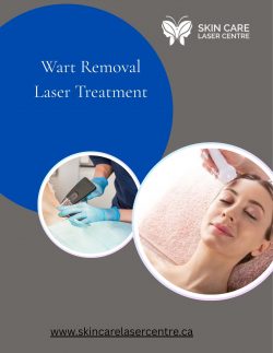 Wart Removal Laser Treatment