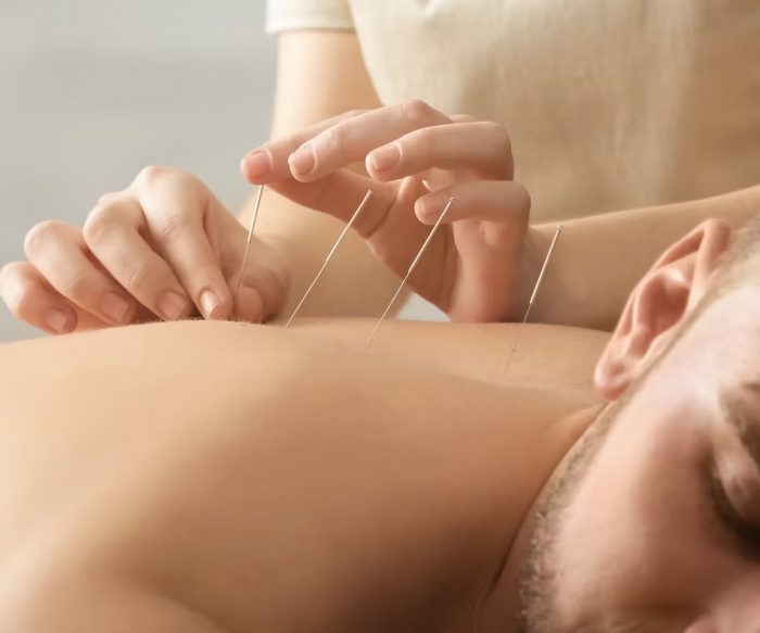 How Does Dry Needling Help Relieve Muscle Pain and Trigger Points?