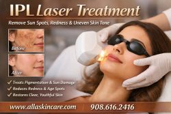 IPL Laser Treatment